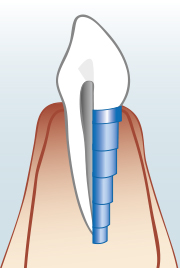 Zahnimplantate - 